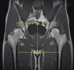 mri hernia sports protocol pelvis msk wo ohsu radiology